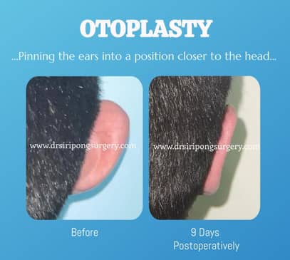 Slider image (5) Dr. Siripong Plastic Surgery in Thailand